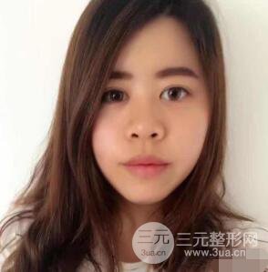 重慶華美何春濤硅膠隆鼻前后對比圖 內(nèi)附恢復(fù)心情小札