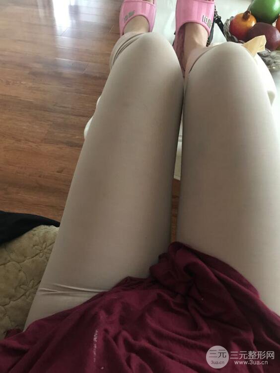 德陽(yáng)東美奧克拉楊華博大腿吸脂前對(duì)對(duì)比圖 四個(gè)月恢復(fù)變化小記