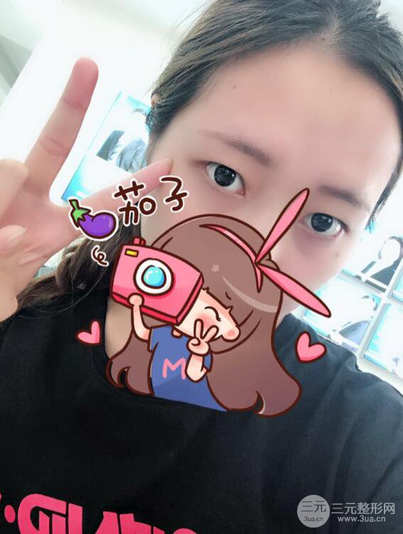 哈醫(yī)大二院整形科肖志波全切雙眼皮前后對(duì)比圖 真實(shí)恢復(fù)經(jīng)歷日記