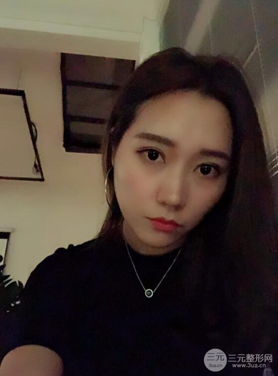 哈醫(yī)大二院整形科肖志波全切雙眼皮前后對(duì)比圖 真實(shí)恢復(fù)經(jīng)歷日記