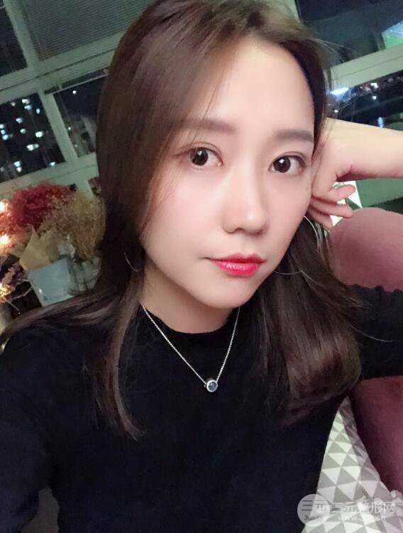 哈醫(yī)大二院整形科肖志波全切雙眼皮前后對(duì)比圖 真實(shí)恢復(fù)經(jīng)歷日記