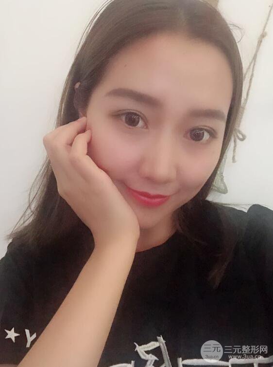 哈醫(yī)大二院整形科肖志波全切雙眼皮前后對(duì)比圖 真實(shí)恢復(fù)經(jīng)歷日記