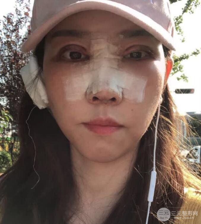 松原齊飛隆鼻整形+雙眼皮一個月前后對比圖真人案例小札
