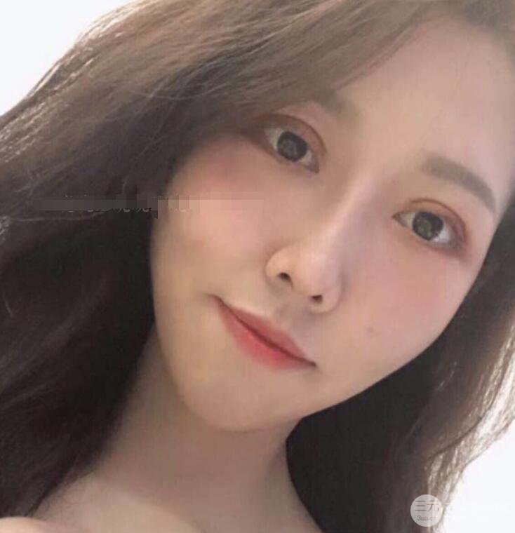 松原齊飛隆鼻整形+雙眼皮一個月前后對比圖真人案例小札