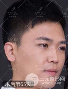 歐陽春雙眼皮前后對比圖 男孩子割雙眼皮一樣好看