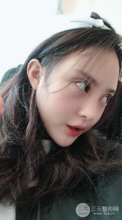 北京美萊趙峻賢隆鼻整形真實案例對比圖恢復過程分享