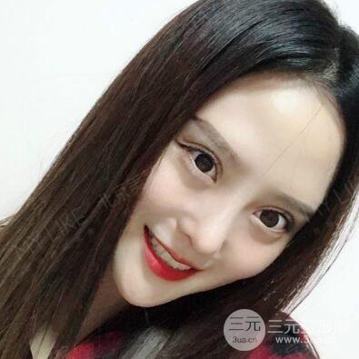 北京美萊趙峻賢隆鼻整形真實案例對比圖恢復過程分享