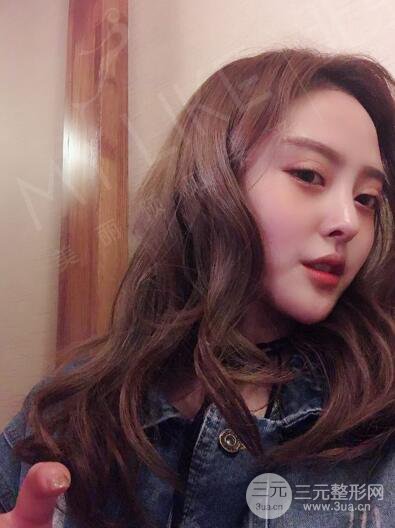 北京美萊趙峻賢隆鼻整形真實案例對比圖恢復過程分享