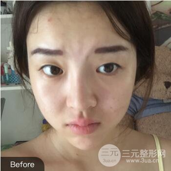 成都天使之翼張勁松切開雙眼皮案例前后對比圖心情小札