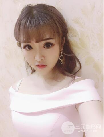 成都天使之翼張勁松切開雙眼皮案例前后對比圖心情小札