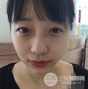 杭州華山連天美高俊明雙眼皮案例前后對比圖心情分享