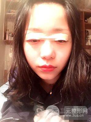 杭州華山連天美高俊明雙眼皮案例前后對比圖心情分享