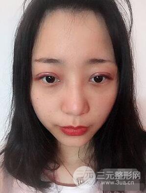 杭州華山連天美高俊明雙眼皮案例前后對比圖心情分享