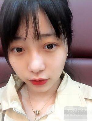 杭州華山連天美高俊明雙眼皮案例前后對比圖心情分享