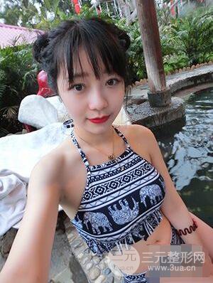 杭州華山連天美高俊明雙眼皮案例前后對比圖心情分享