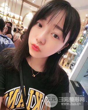 杭州華山連天美高俊明雙眼皮案例前后對比圖心情分享