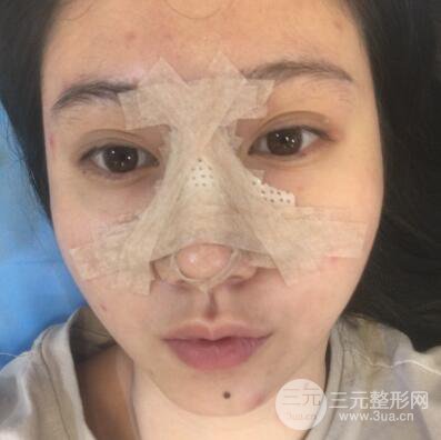 合肥壹加壹王大勇假體隆鼻果對比圖 45天恢復(fù)心路歷程