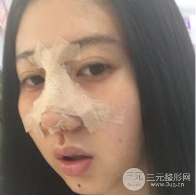 合肥壹加壹王大勇假體隆鼻果對比圖 45天恢復(fù)心路歷程