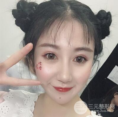 合肥壹加壹王大勇假體隆鼻果對比圖 45天恢復(fù)心路歷程