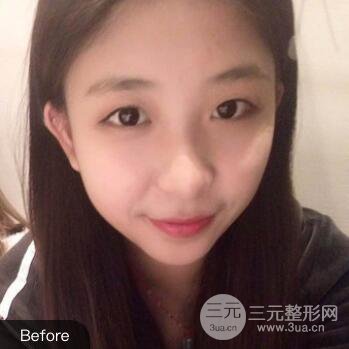 沈陽(yáng)軍區(qū)總醫(yī)院時(shí)杰切開雙眼皮案例對(duì)比圖|內(nèi)附心情恢復(fù)小札哦