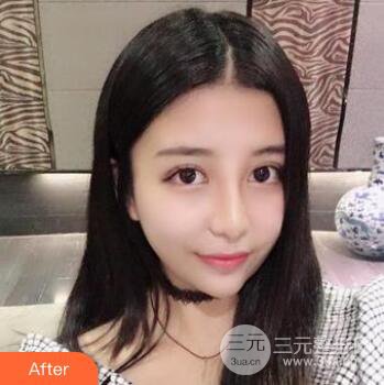 沈陽(yáng)軍區(qū)總醫(yī)院時(shí)杰切開雙眼皮案例對(duì)比圖|內(nèi)附心情恢復(fù)小札哦