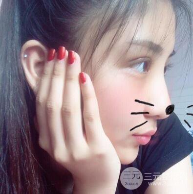 沈陽(yáng)軍區(qū)總醫(yī)院時(shí)杰切開雙眼皮案例對(duì)比圖|內(nèi)附心情恢復(fù)小札哦