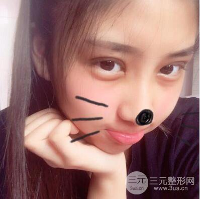 沈陽(yáng)軍區(qū)總醫(yī)院時(shí)杰切開雙眼皮案例對(duì)比圖|內(nèi)附心情恢復(fù)小札哦