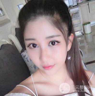 沈陽(yáng)軍區(qū)總醫(yī)院時(shí)杰切開雙眼皮案例對(duì)比圖|內(nèi)附心情恢復(fù)小札哦