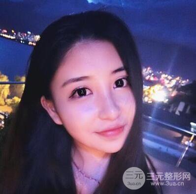 沈陽(yáng)軍區(qū)總醫(yī)院時(shí)杰切開雙眼皮案例對(duì)比圖|內(nèi)附心情恢復(fù)小札哦