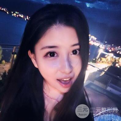 沈陽(yáng)軍區(qū)總醫(yī)院時(shí)杰切開雙眼皮案例對(duì)比圖|內(nèi)附心情恢復(fù)小札哦