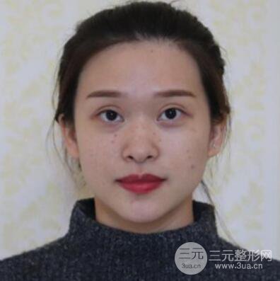 哈爾濱哈美萊鄭東學隆鼻整形案例對比圖真實心情分享喲~