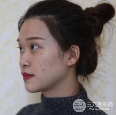 哈爾濱哈美萊鄭東學隆鼻整形案例對比圖真實心情分享喲~