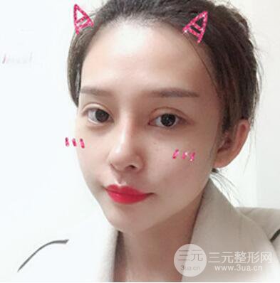 哈爾濱哈美萊鄭東學隆鼻整形案例對比圖真實心情分享喲~