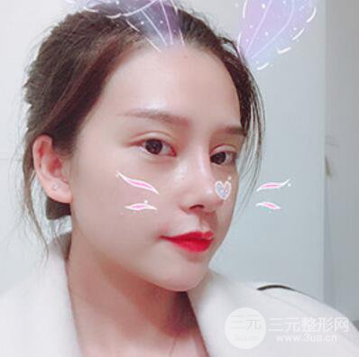 哈爾濱哈美萊鄭東學隆鼻整形案例對比圖真實心情分享喲~