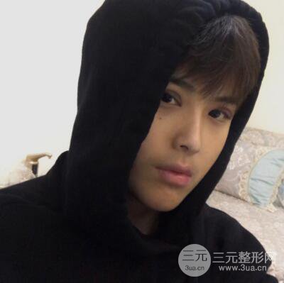 哈醫(yī)大二院整形科肖志波割雙眼皮對比圖男性案例