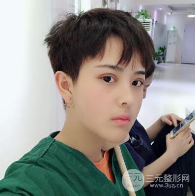哈醫(yī)大二院整形科肖志波割雙眼皮對比圖男性案例