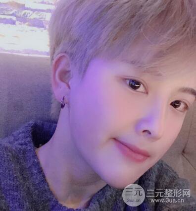 哈醫(yī)大二院整形科肖志波割雙眼皮對比圖男性案例