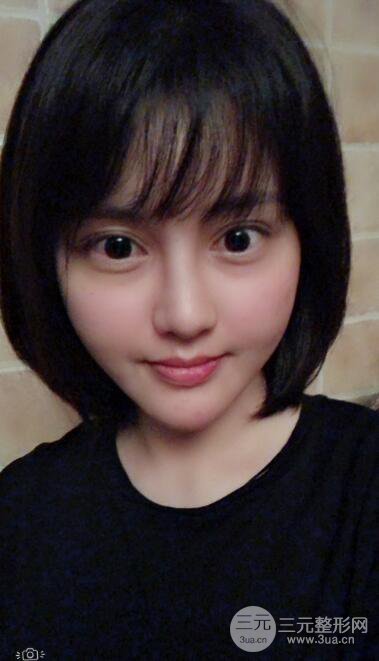 常州施爾美廉鋒自體脂肪豐臉對照圖案例心情日扎