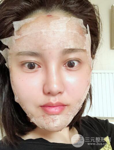 常州施爾美廉鋒自體脂肪豐臉對照圖案例心情日扎