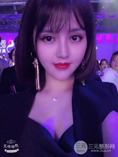 常州施爾美廉鋒自體脂肪豐臉對照圖案例心情日扎