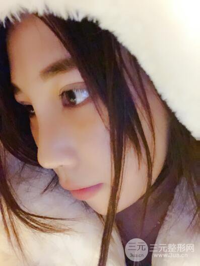 貴陽麗都李觀龍隆鼻整形案例對照圖一個(gè)月恢復(fù)過程分享