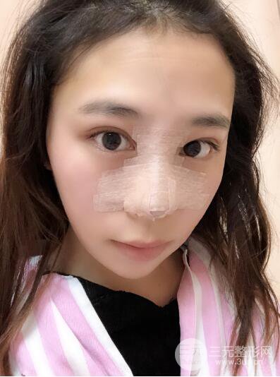 貴陽麗都李觀龍隆鼻整形案例對照圖一個(gè)月恢復(fù)過程分享