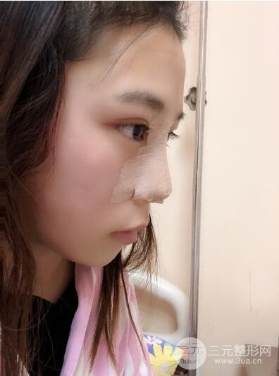 貴陽麗都李觀龍隆鼻整形案例對照圖一個(gè)月恢復(fù)過程分享