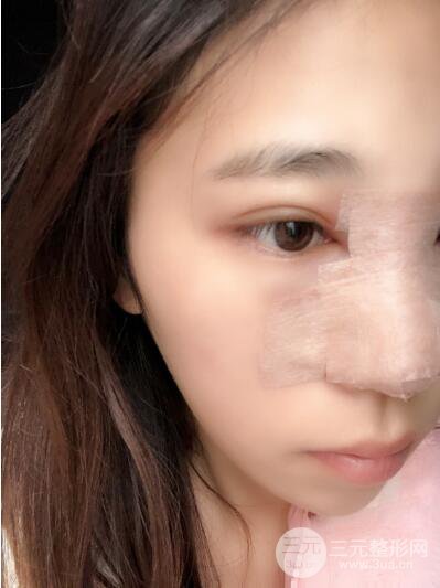 貴陽麗都李觀龍隆鼻整形案例對照圖一個(gè)月恢復(fù)過程分享