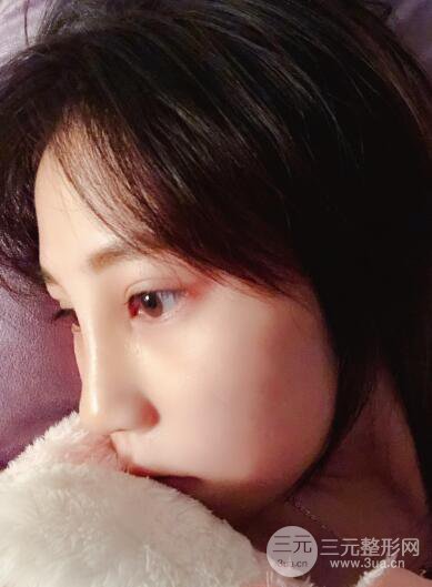 貴陽麗都李觀龍隆鼻整形案例對照圖一個(gè)月恢復(fù)過程分享