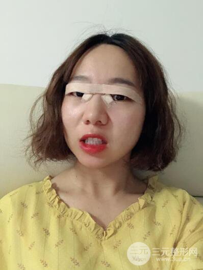 湘潭華美切開(kāi)雙眼皮案例對(duì)照?qǐng)D兩個(gè)月恢復(fù)過(guò)程心情日扎