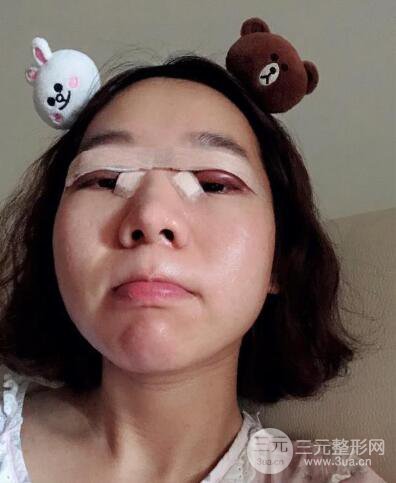 湘潭華美切開(kāi)雙眼皮案例對(duì)照?qǐng)D兩個(gè)月恢復(fù)過(guò)程心情日扎