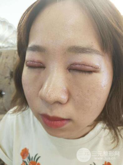 湘潭華美切開(kāi)雙眼皮案例對(duì)照?qǐng)D兩個(gè)月恢復(fù)過(guò)程心情日扎