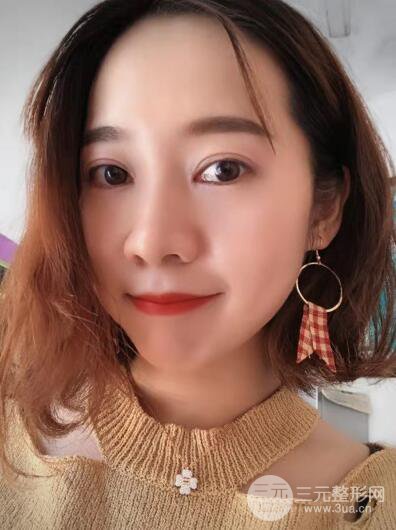 湘潭華美切開(kāi)雙眼皮案例對(duì)照?qǐng)D兩個(gè)月恢復(fù)過(guò)程心情日扎