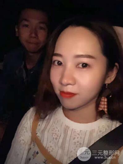 湘潭華美切開(kāi)雙眼皮案例對(duì)照?qǐng)D兩個(gè)月恢復(fù)過(guò)程心情日扎